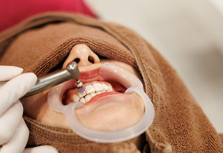 STEP 6：歯のコーティング