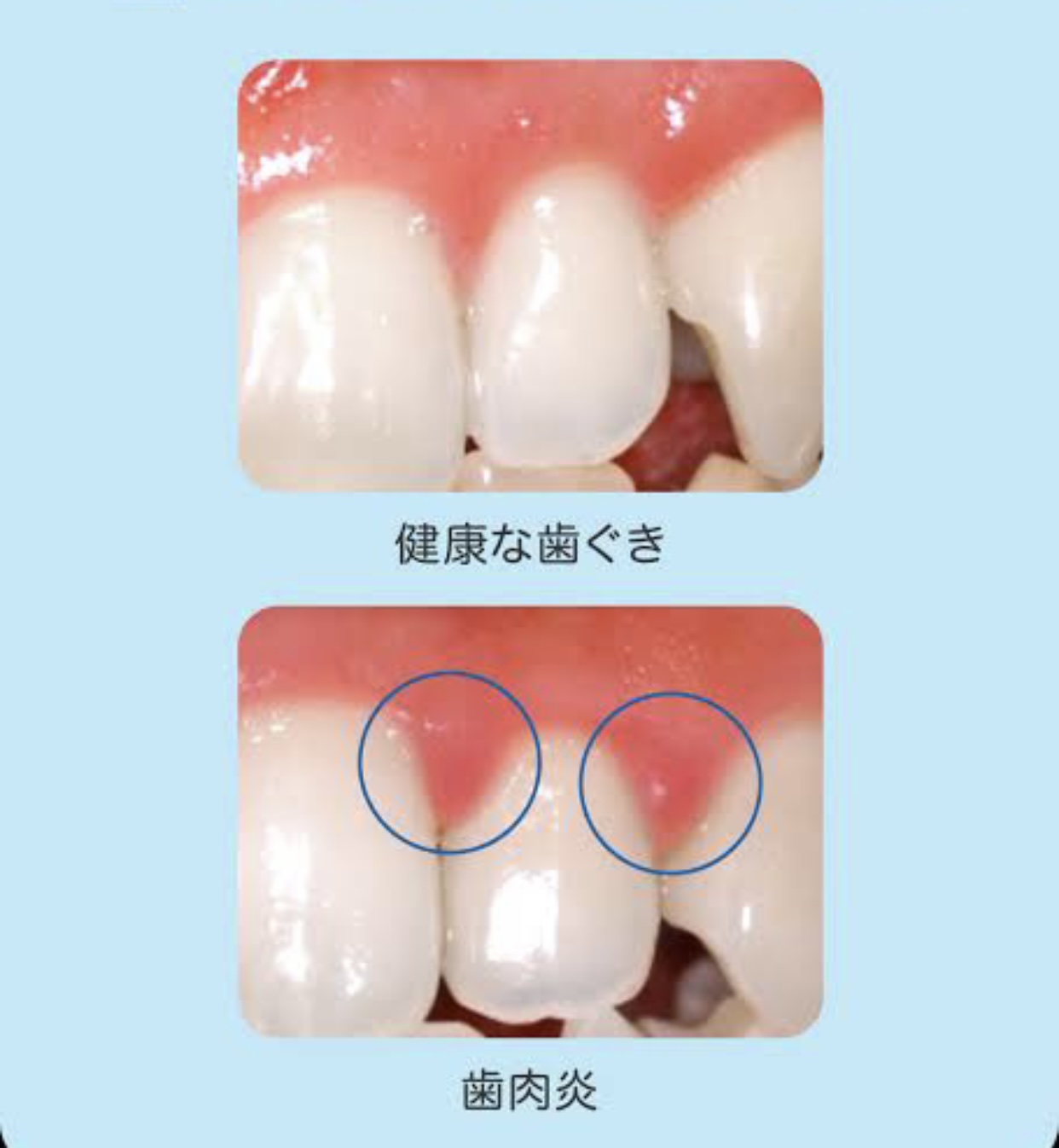 お子さんに多い歯肉炎