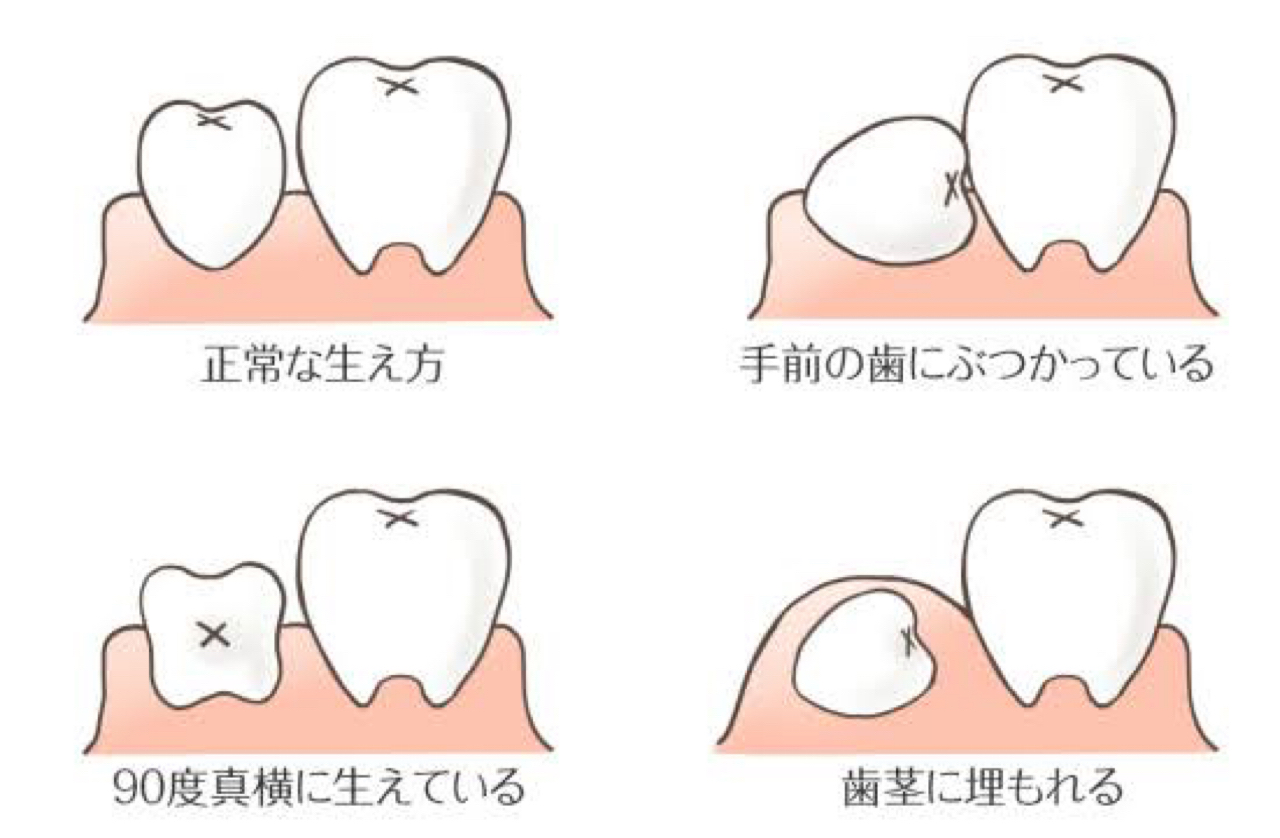 親知らず🦷✨