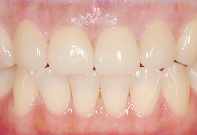 ケース1：前歯の歯並び、歯の欠けが気になる方。After