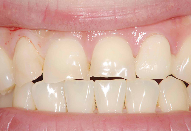 ケース1：前歯の歯並び、歯の欠けが気になる方。Before