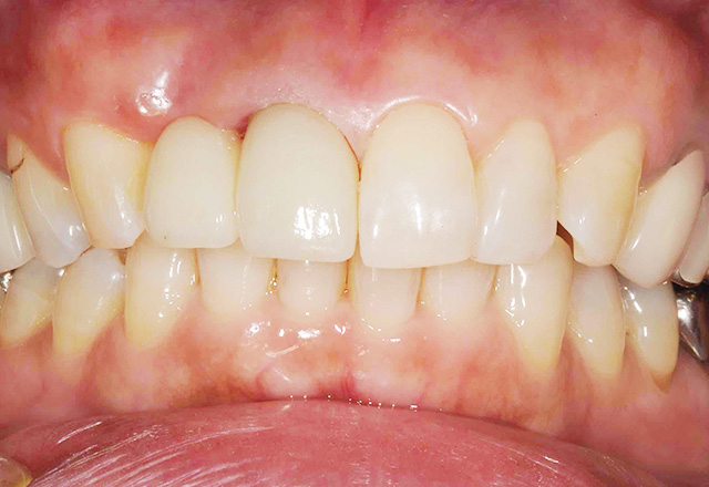 ケース2：インプラントや入れ歯に抵抗があり、歯を削りたくない方。After