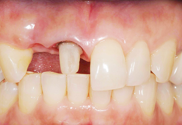 ケース2：インプラントや入れ歯に抵抗があり、歯を削りたくない方。Before