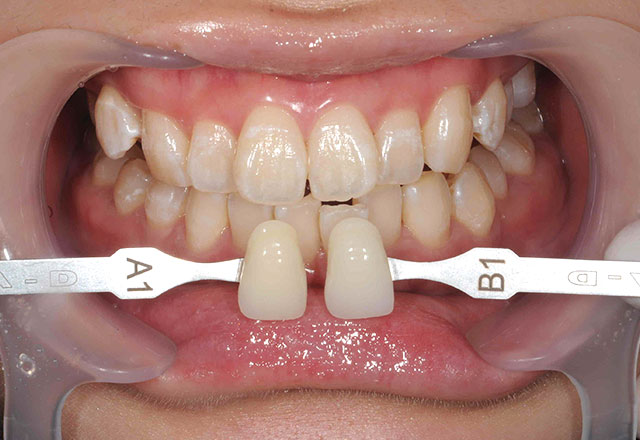 ケース1：オフィスホワイトニング（2回） After