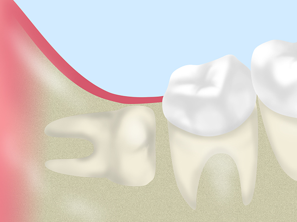 親知らずの抜歯